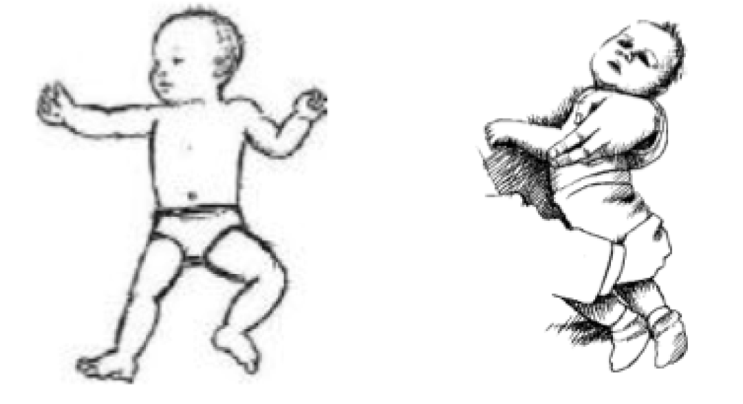 Behandeling Kiss Syndroom